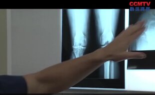 E Janssen：全膝关节置换术1
